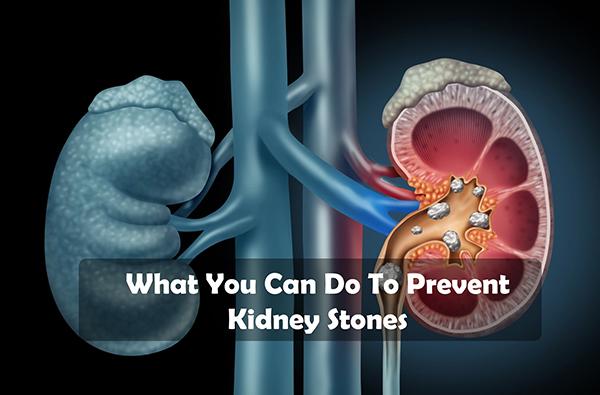Kidney Stones Prevention Guide