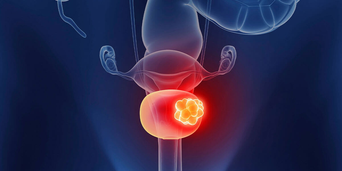 Bladder Cancer TURBT